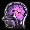 Mild traumatic brain injury
